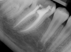 begley dental root canal